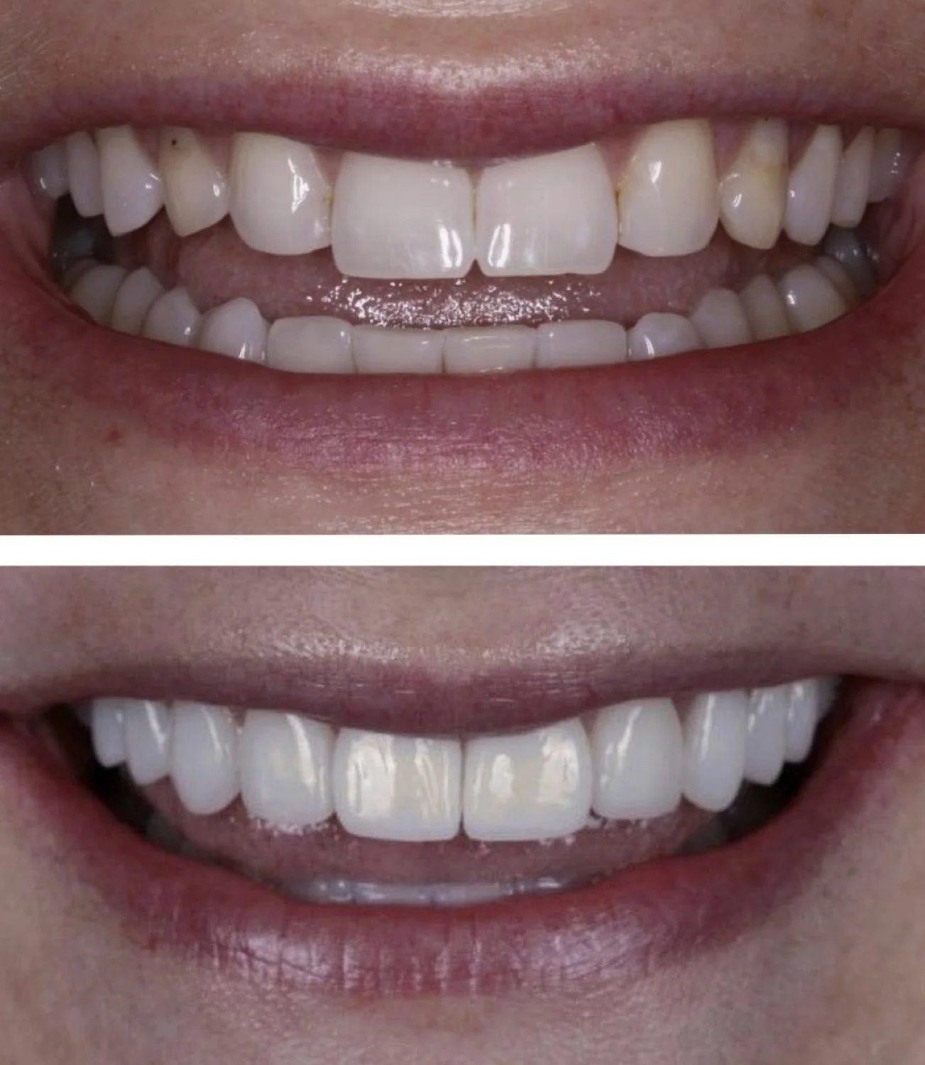 10 no prep veneers before and after by Dr. Brittany Dickinson, Chicago Aesthetic Dentistry, Lakeview.
