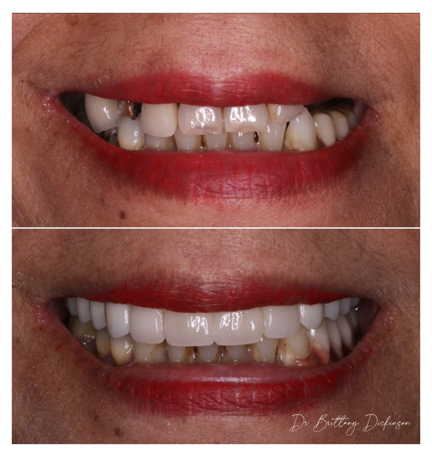 2 implant bridges and 4 porcelain veneers before and after by Dr. Brittany Dickinson, Chicago Aesthetic Dentistry, Lakeview.