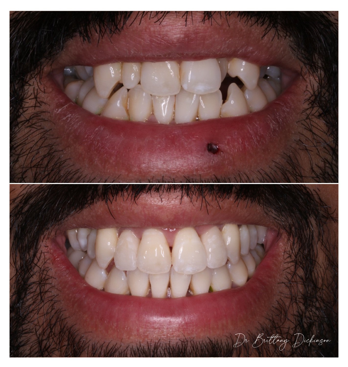 Pulled extra teeth, invisalign and 2 porcelain veneers before and after by Dr. Brittany Dickinson — Chicago Lakeview.