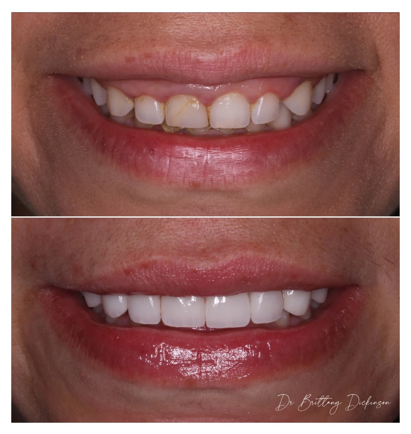 Crown lengthening and 10 porcelain veneers with botox gummy smile before and after by Dr. Brittany Dickinson, Chicago.