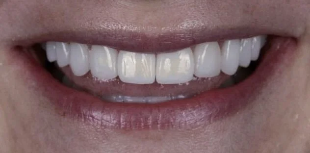 Close-up smile after no-prep porcelain-composite hybrid veneers by Dr. Brittany Dickinson, a Chicago cosmetic dentist in Lakeview — natural, brighter, fuller, with zero enamel removed.