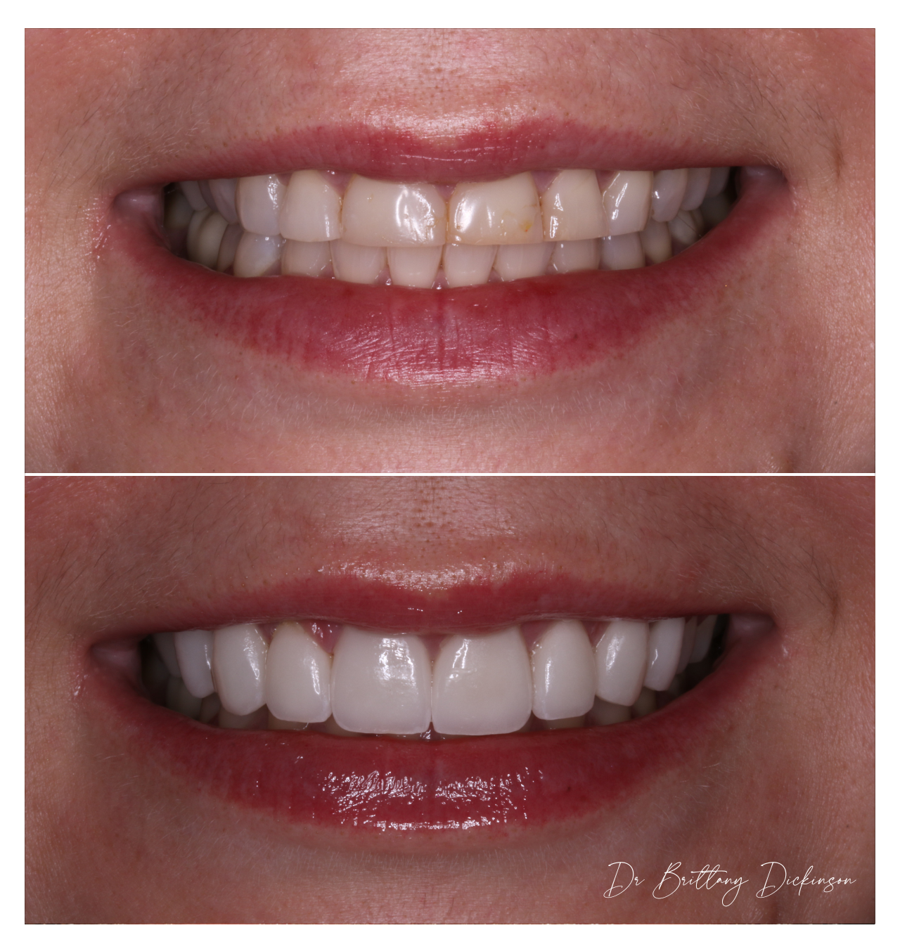 Porcelain veneers restoring worn and chipped incisal edges, before and after smile transformation by Dr. Brittany Dickinson, Chicago Aesthetic Dentistry