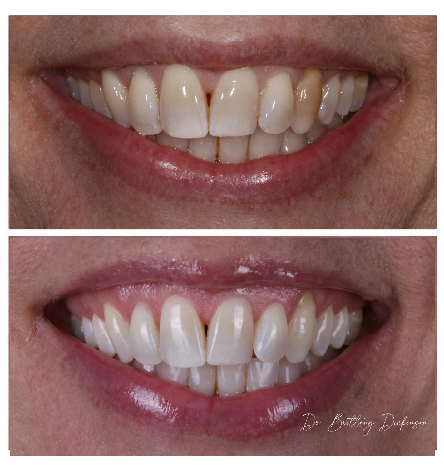 Kor whitening before and after by Dr. Brittany Dickinson, Chicago Aesthetic Dentistry, Lakeview.