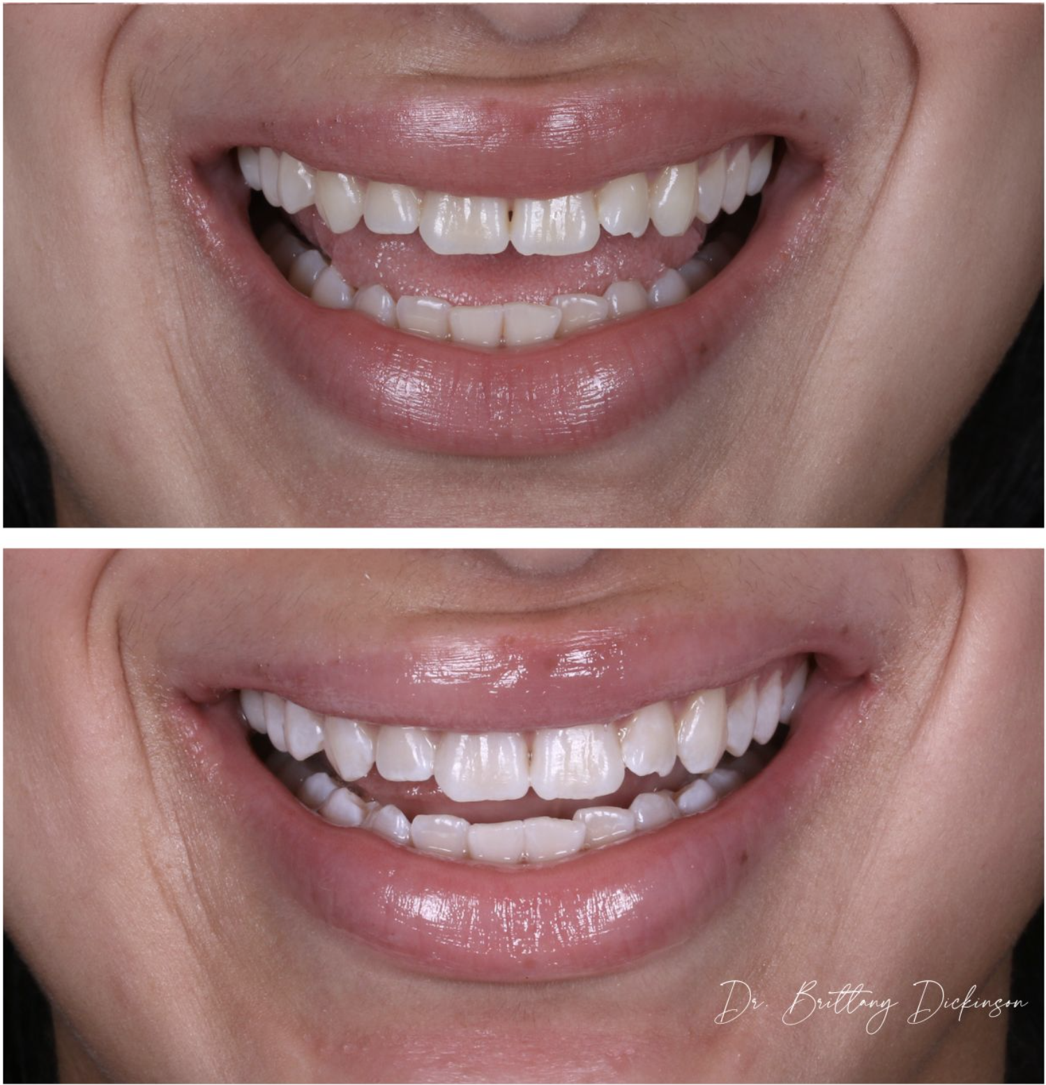 Before and after images of teeth whitening, showing a close-up of a person's smile. The top image displays slightly discolored teeth, while the bottom image shows whiter, brighter teeth post-treatment.