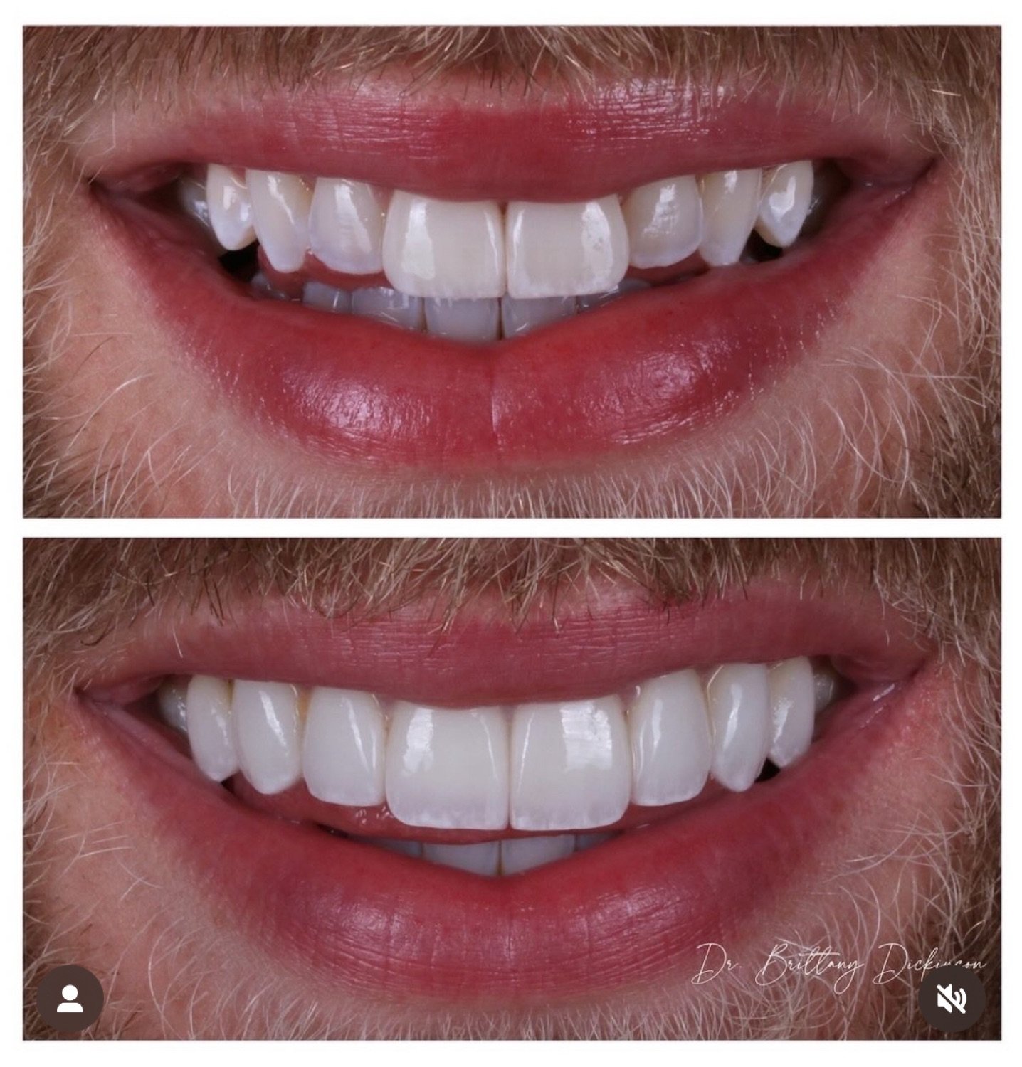 10 porcelain veneers before and after by Dr. Brittany Dickinson, Chicago Aesthetic Dentistry, Lakeview.