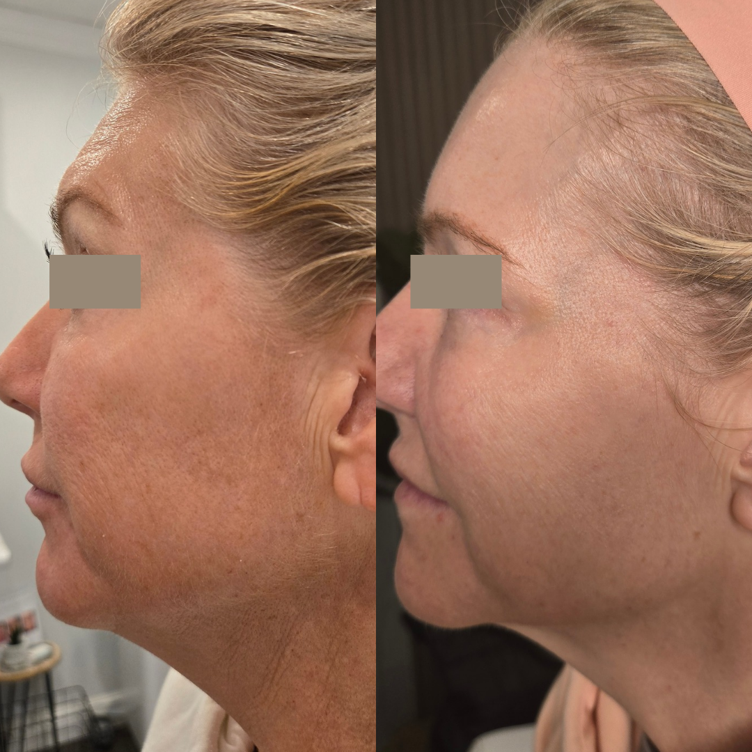 Side-by-side comparison of a woman's face showing before and after skincare treatment, with improvements in skin texture and appearance.