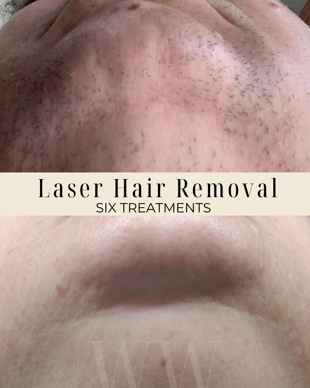 A before and after comparison of a person's chin area showing the results of laser hair removal over six treatments, with the upper image showing hairy skin and the lower image showing smooth skin.