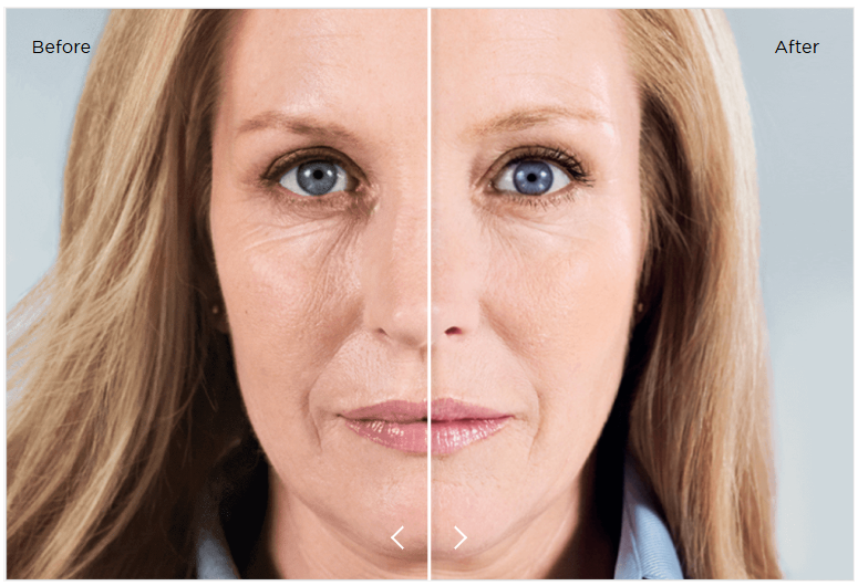 Sculptra before and after