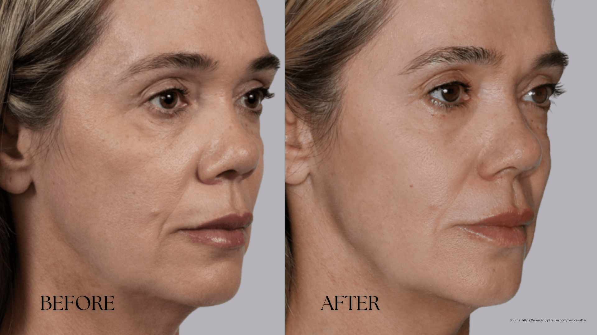 TDWP2 Sculptra before and after blog