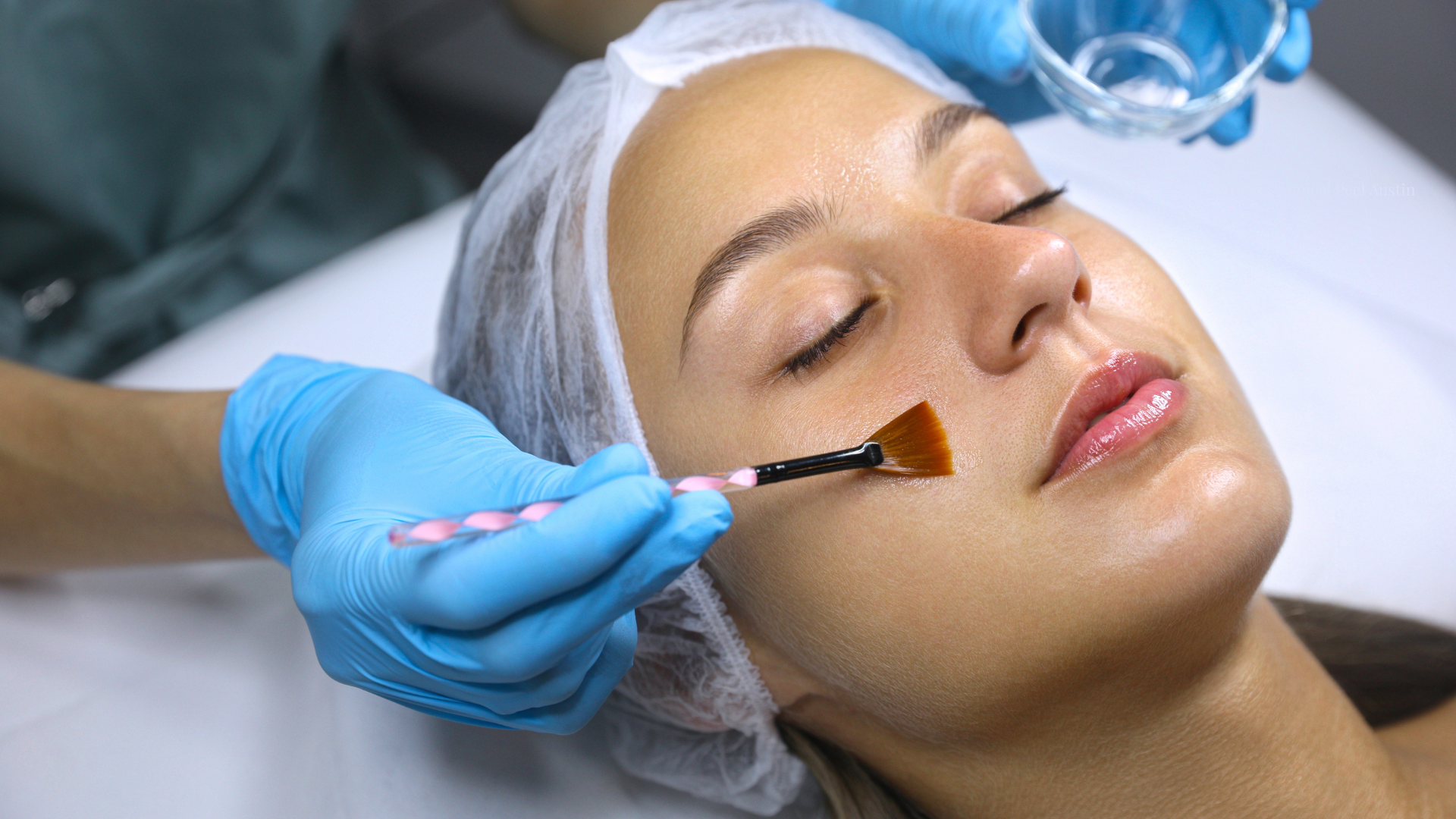 Chemical peel anti aging Austin