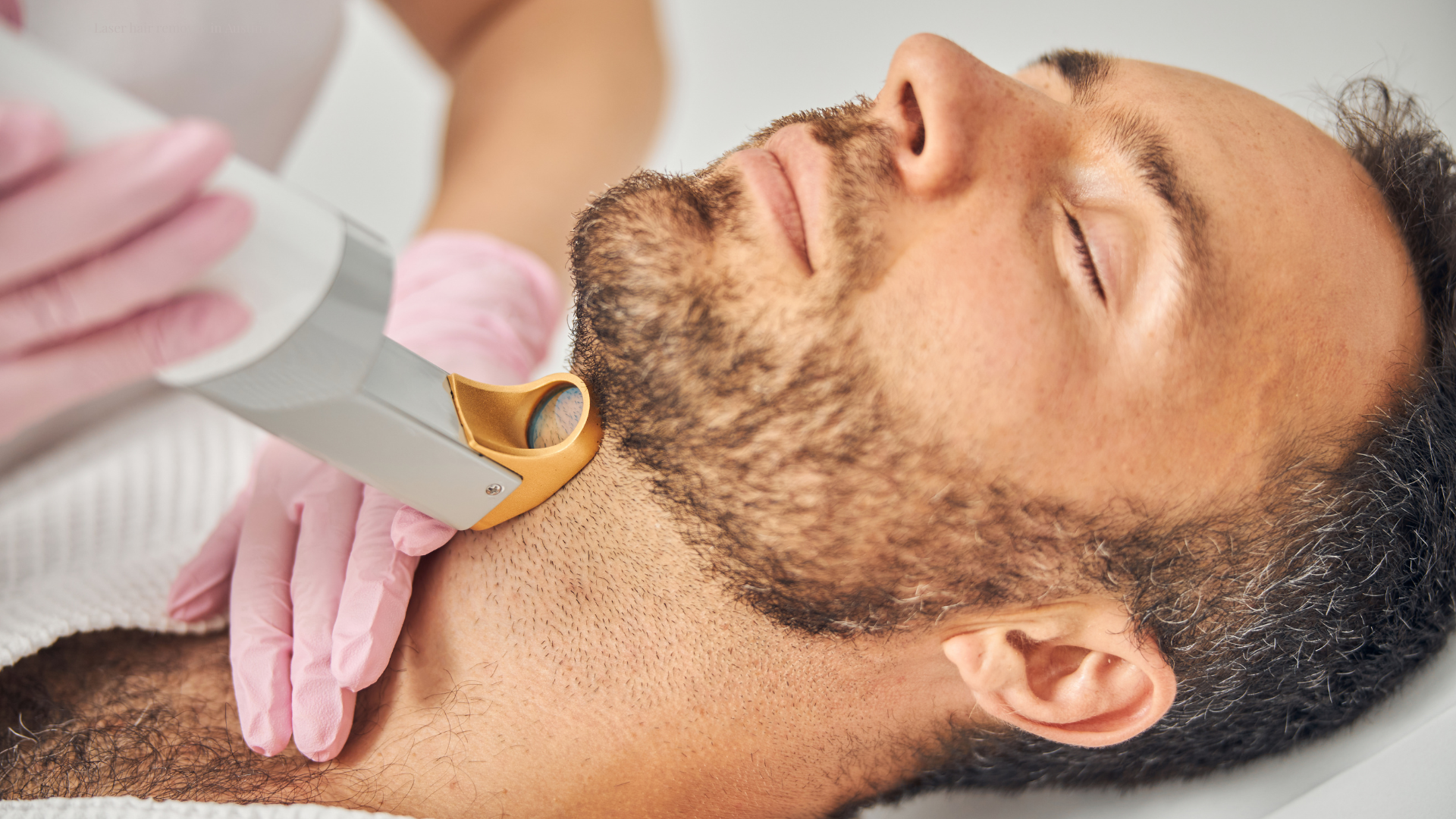 Laser hair removal for men