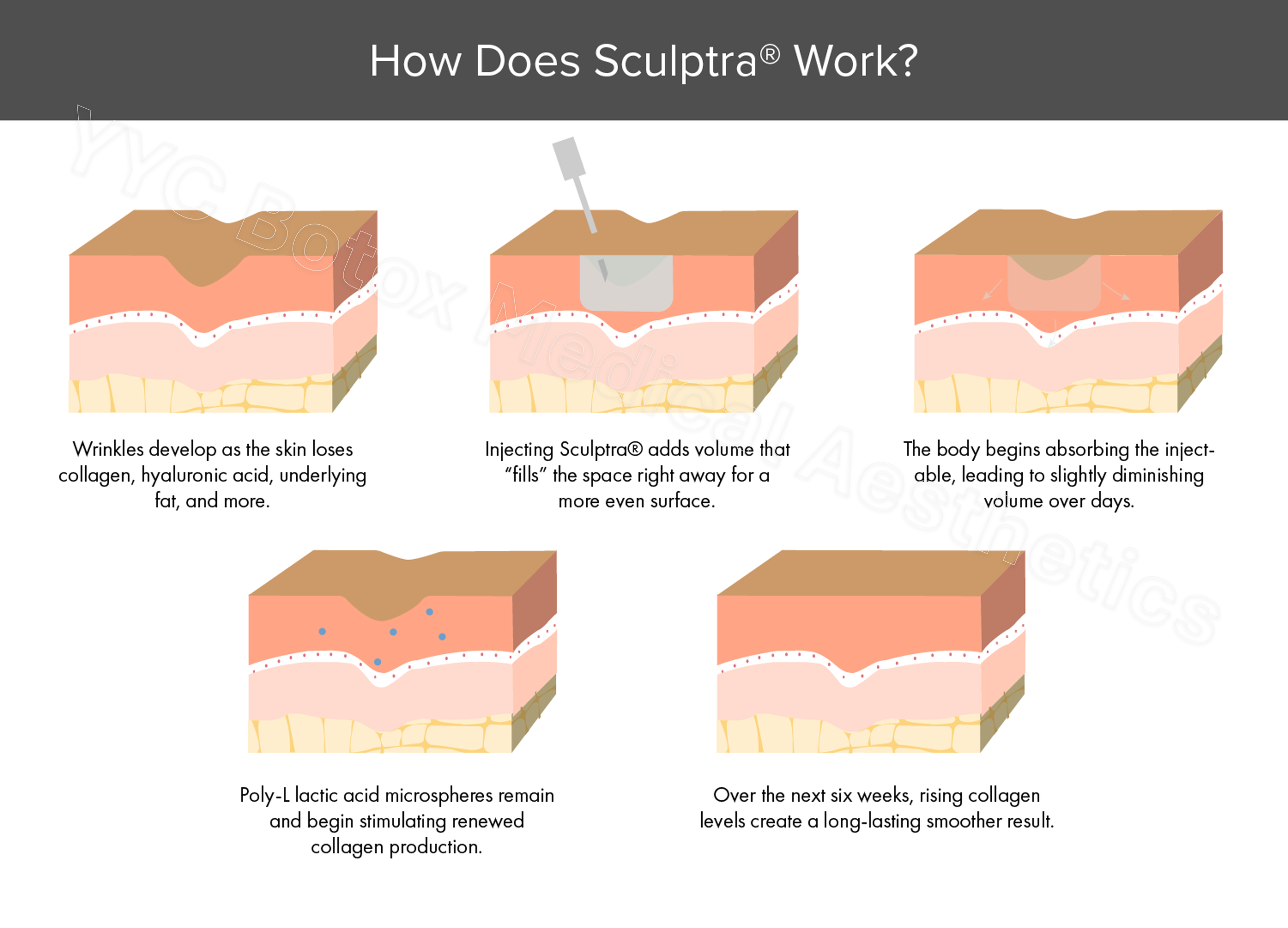 sculptra collagen renewal process