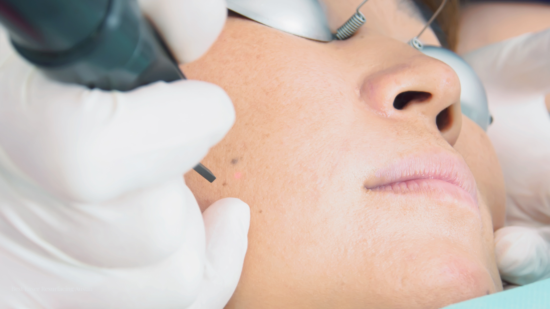 Laser resurfacing procedure Austin