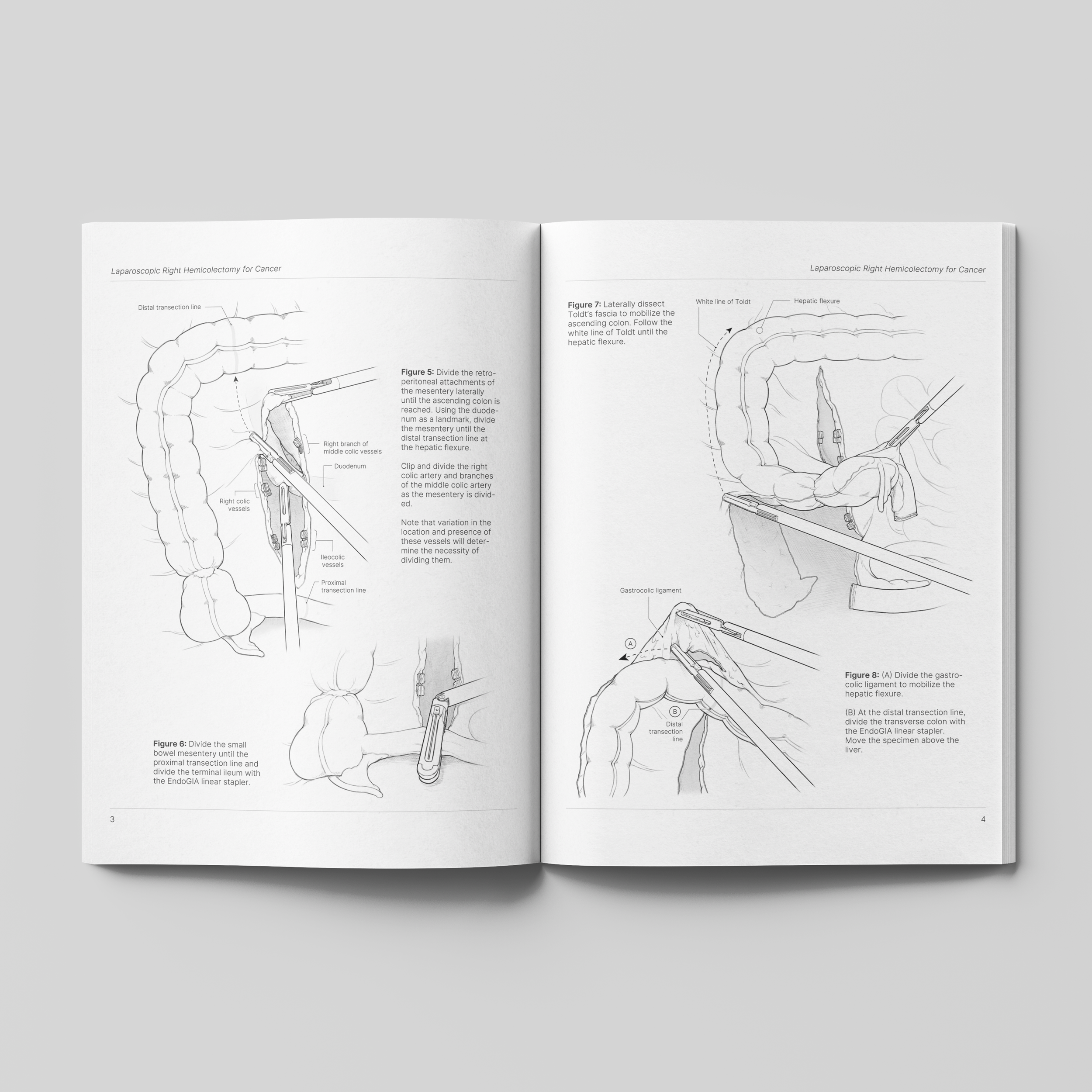 Right Hemicolectomy for Cancer - Surgical Illustration