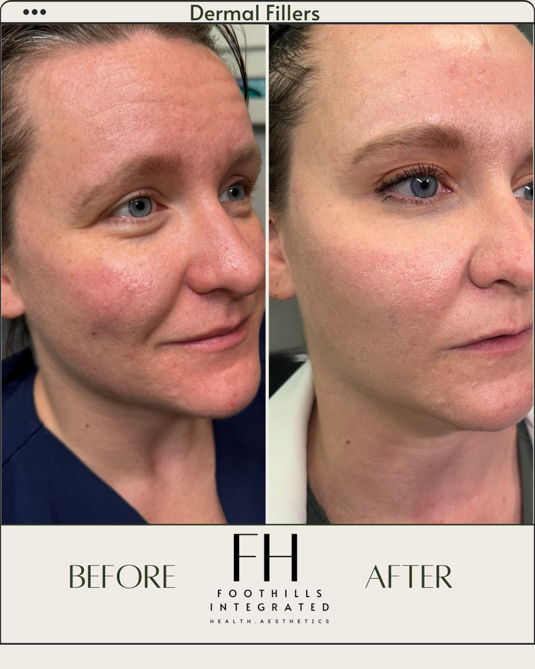Side-by-side comparison of a woman's face before and after dermal filler treatment, showing improved skin texture and reduced redness, with the 'before' on the left and 'after' on the right, under the logo of Foothills Integrated Health & Aesthetics.