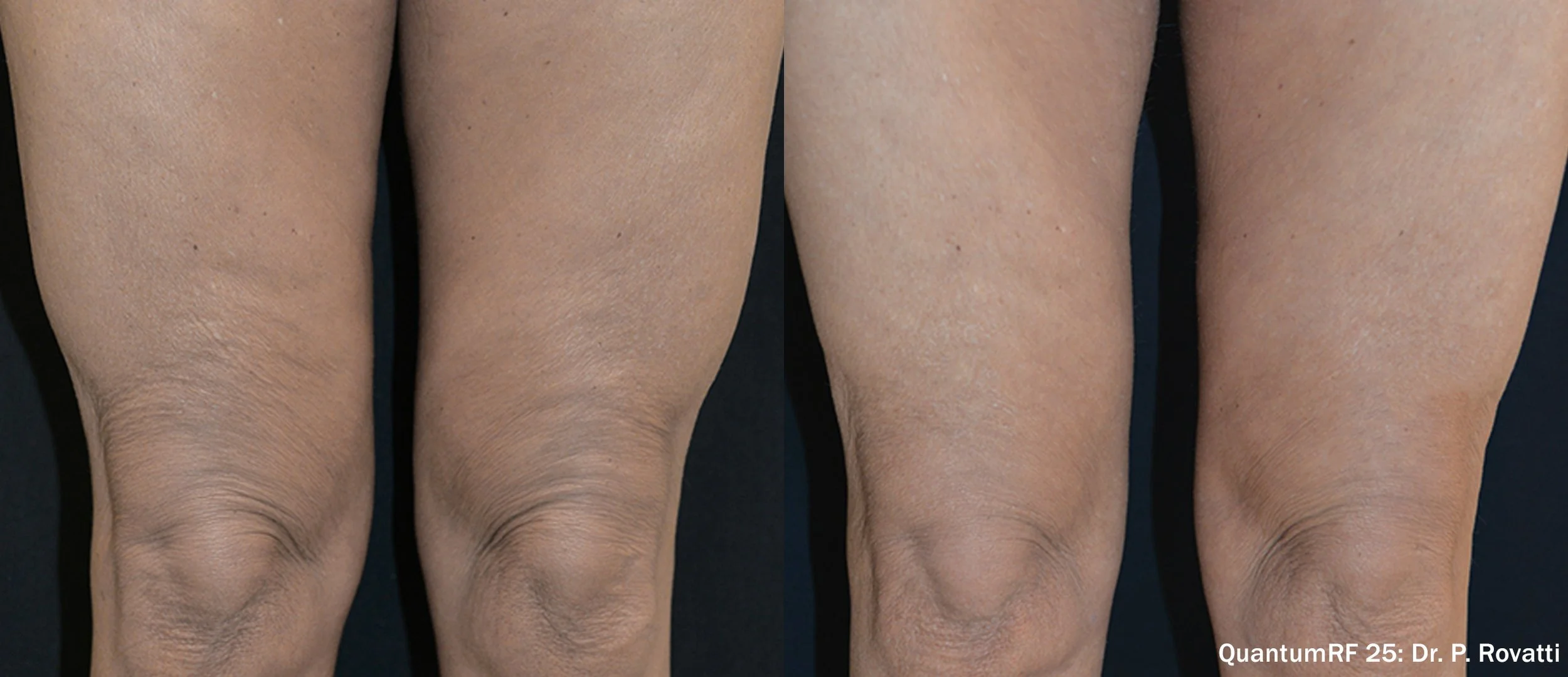 Close-up comparison of skin on knees showing before and after treatment, with smoother and more even skin in the after image