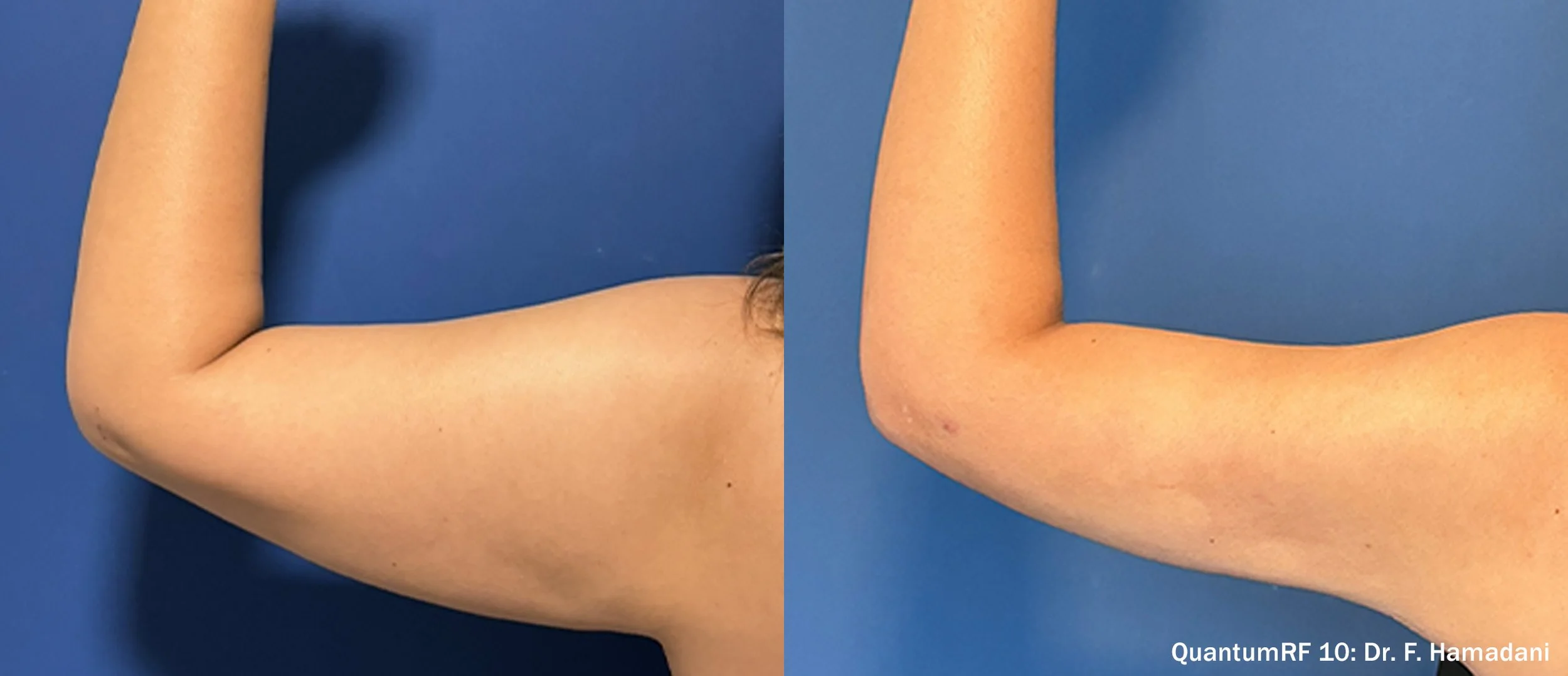 Side-by-side comparison of a person's arm before and after a cosmetic procedure, with the former showing a slightly looser skin and the latter showing firmer skin.