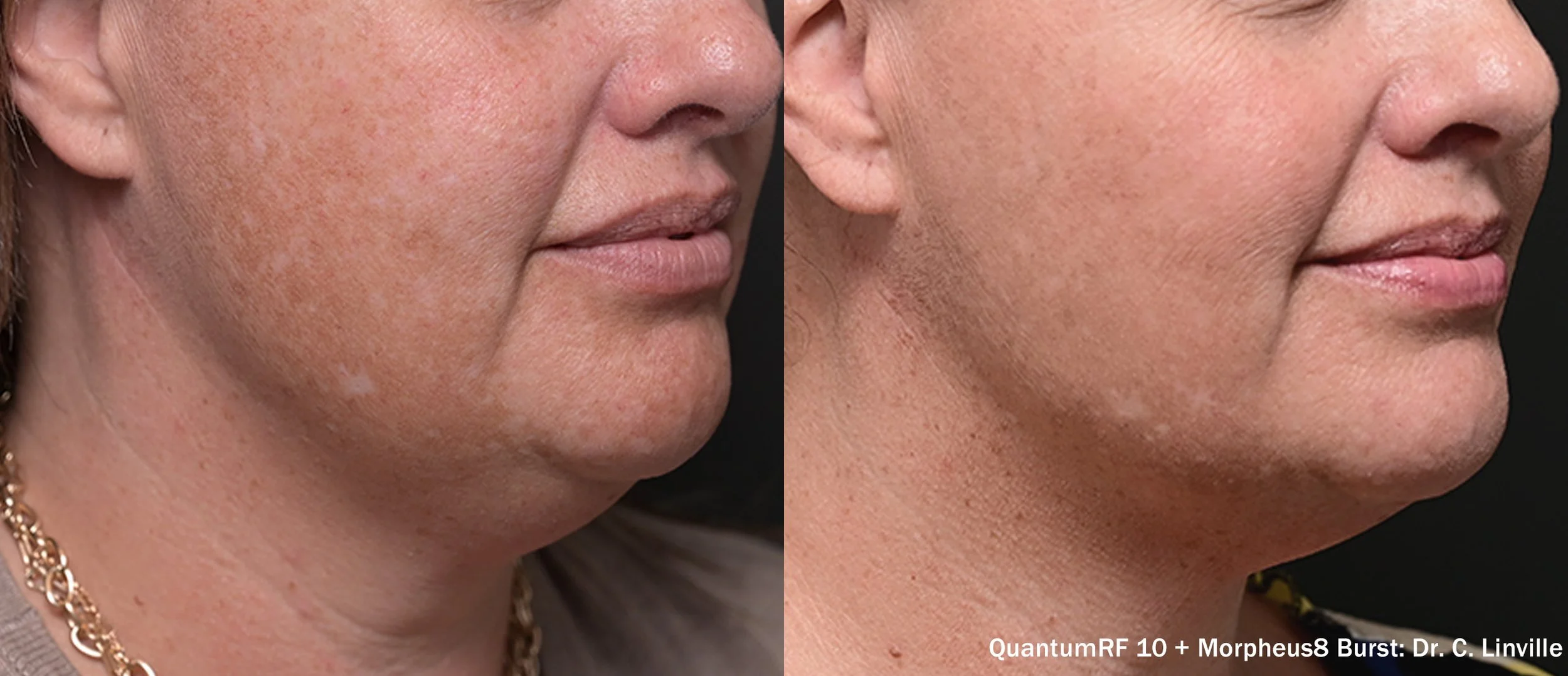 Comparison of a woman's face before and after skin treatment showing clear, smooth skin on the right side.