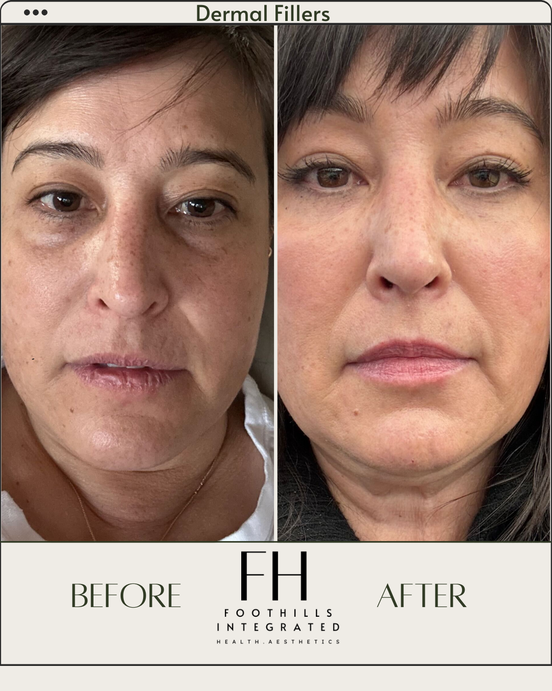 Side-by-side comparison of a woman's face before and after dermal filler treatment, showing improved skin texture and reduced wrinkles.