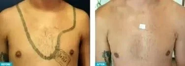 Comparison of a man's chest before and after a medical procedure, showing reduced chest hair and a small scar or mark on the after image.