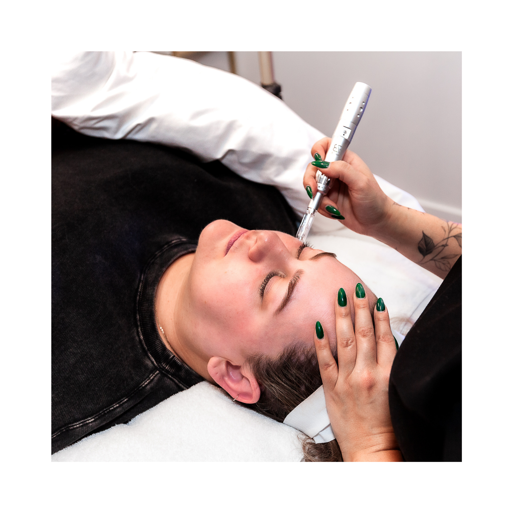 A woman receiving a microneedling procedure with an e-pen on her forehead while lying down, with her eyes closed and hand on her forehead.