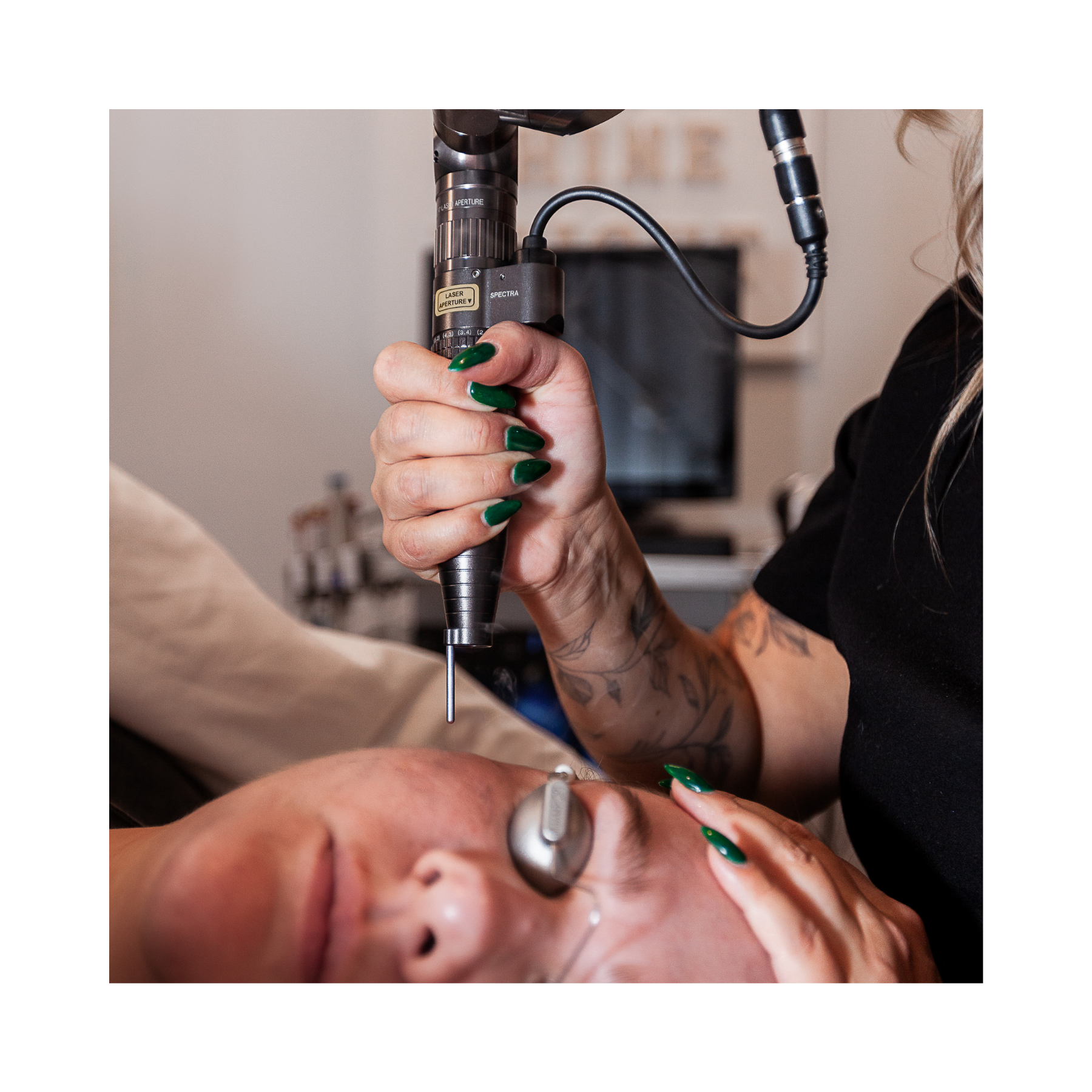 A person is receiving a fractional laser treatment for anti aging