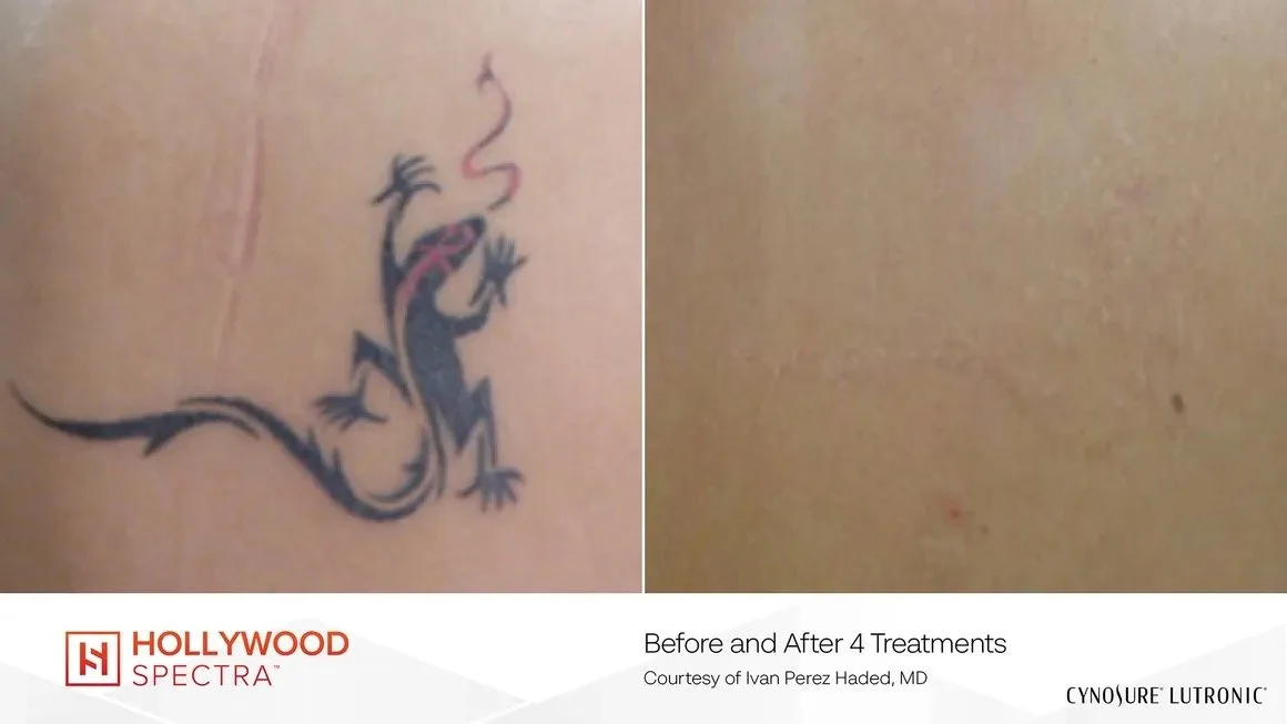 Tattoo of a lizard on skin, shown before and after four treatments.