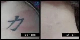 Tattoo of a Chinese character on skin, before and after removal