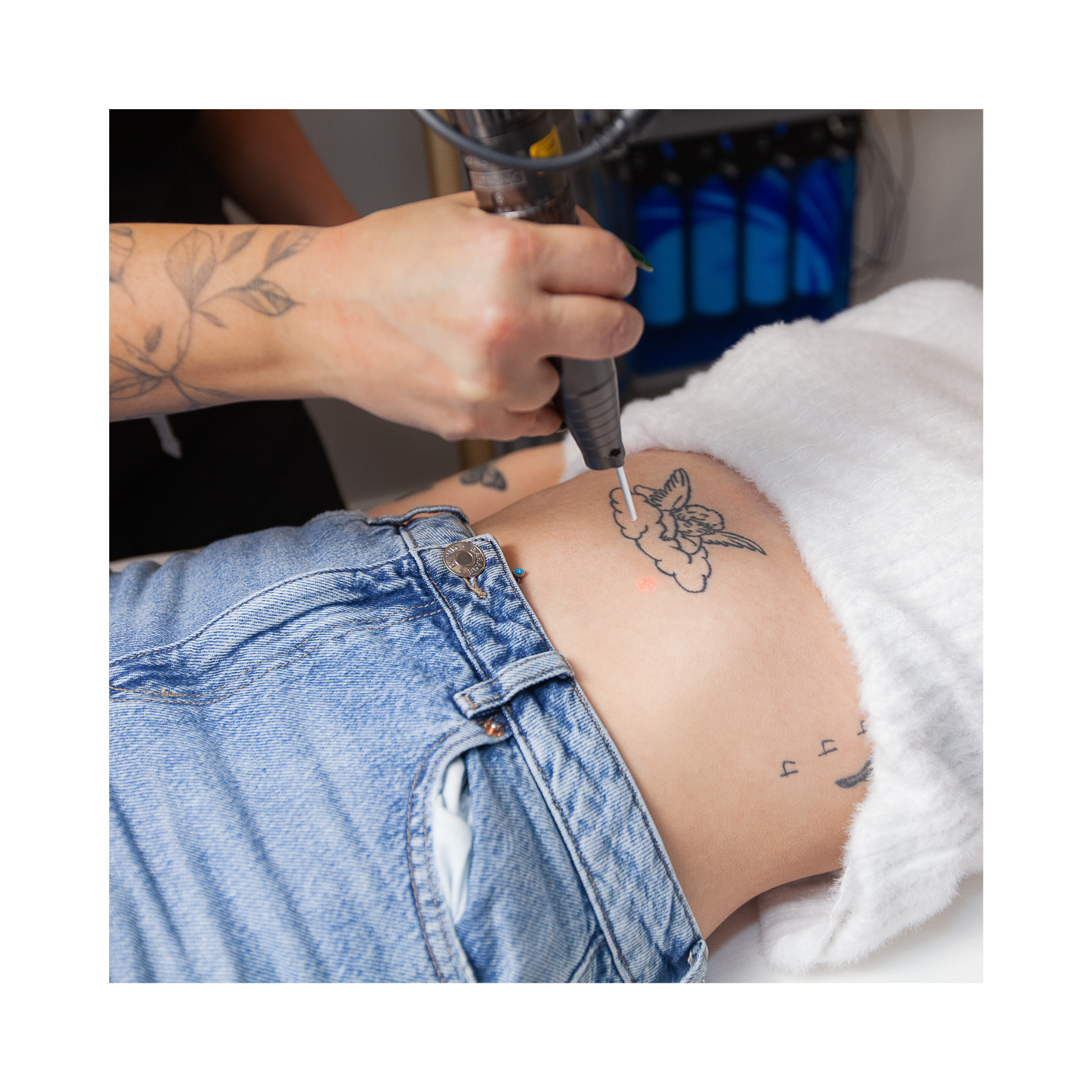 A person is getting a laser tattoo removal