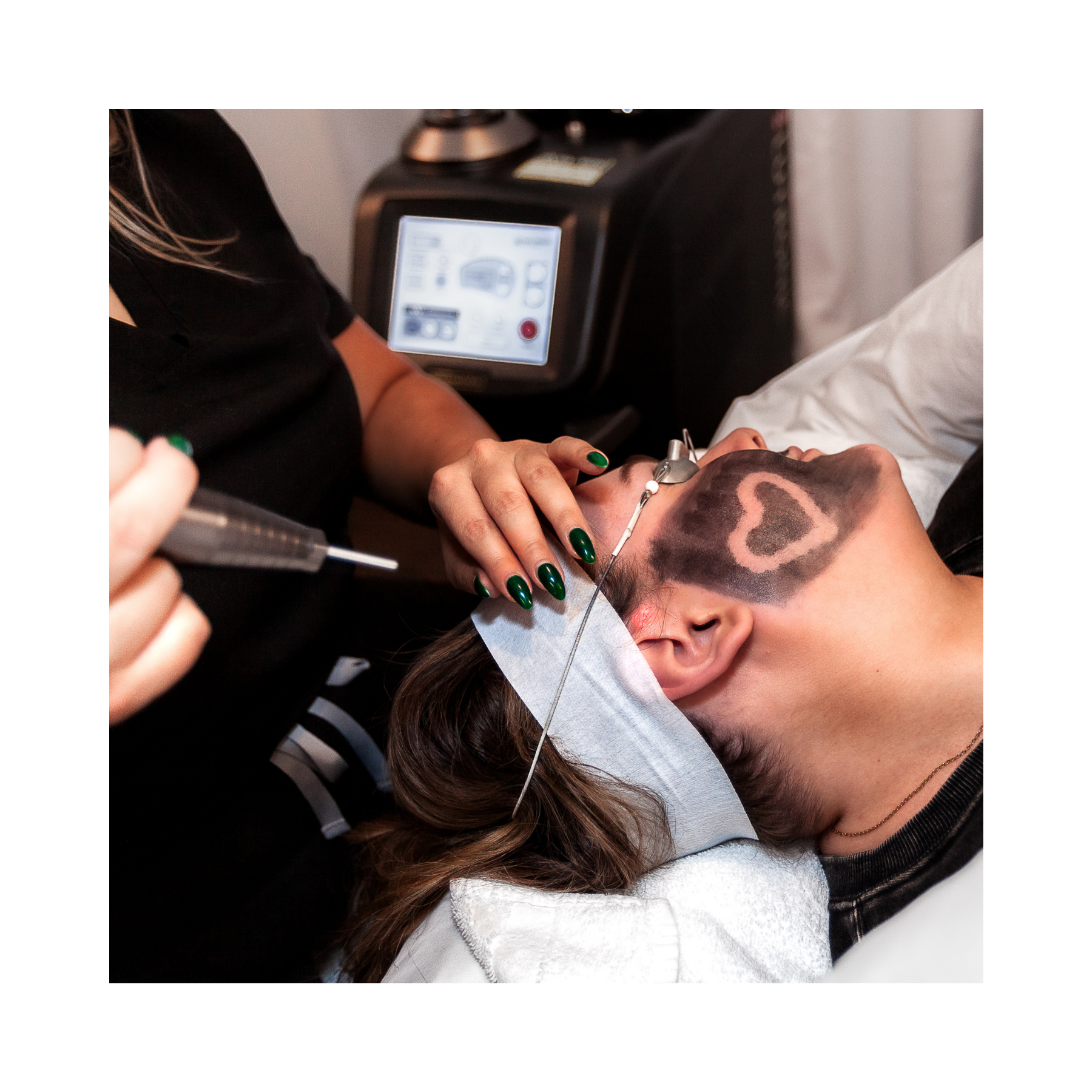 A person is lying on a medical bed receiving a carbon laser peel treatment with the Hollywood Spectra