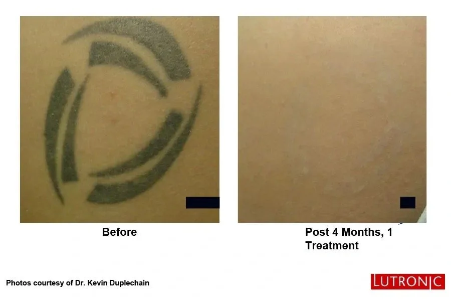 Tattoo of circular shapes on skin, before and after treatment with fading visible after 4 months.