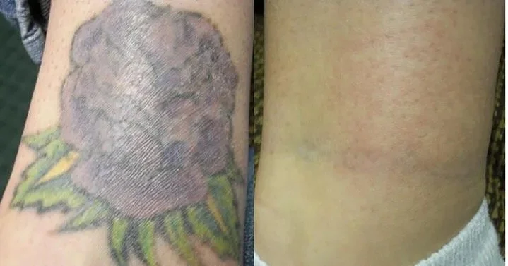 Close-up of a person's arm with a fresh tattoo of a pineapple on the left, and the same arm with no tattoo on the right, showing the tattoo removal process.