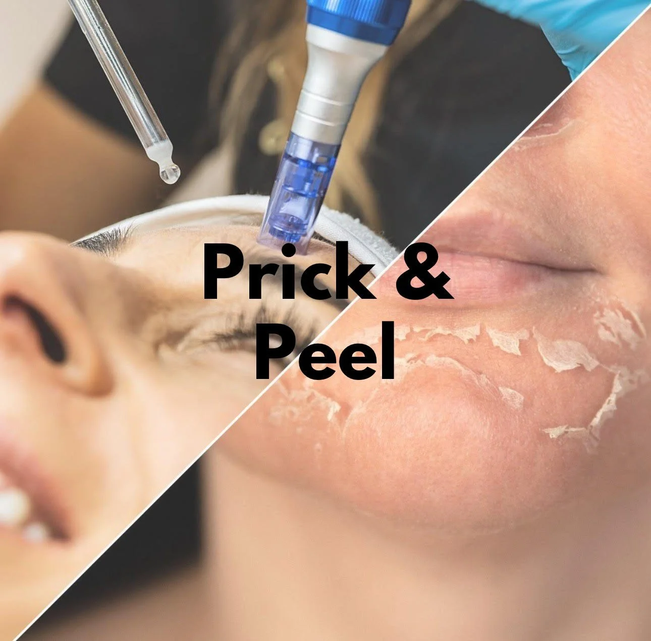 Prick and Peel Package