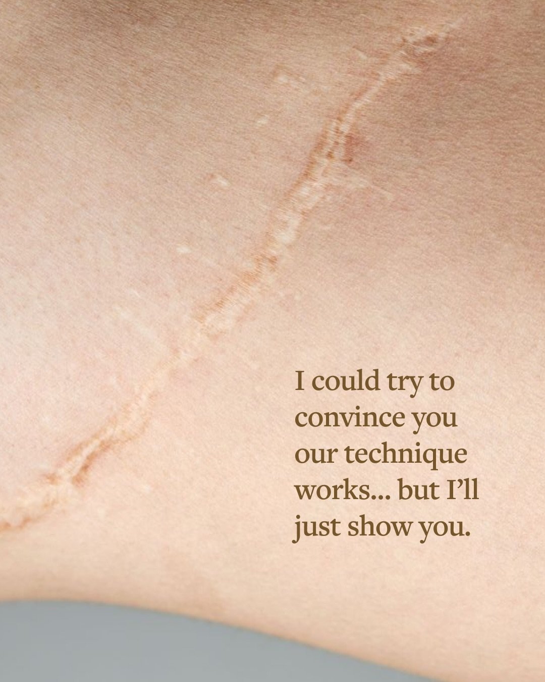 These results highlight how scar camouflage and ISR can help improve the appearance of scars while maintaining a natural skin look. Every treatment is customized to your skin, your goals, and your healing journey.

Swipe to see the transformations an