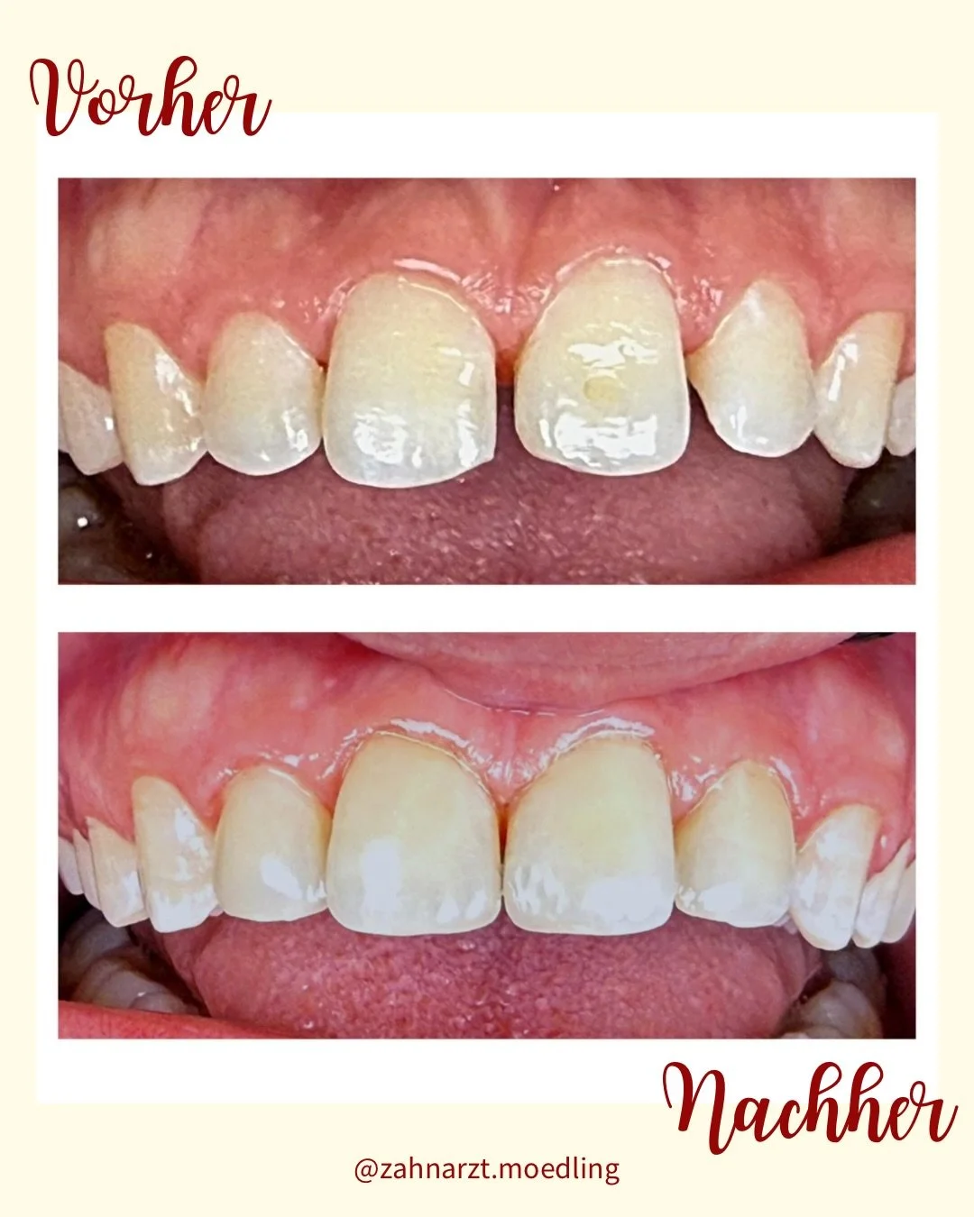 Kleine Ver&auml;nderung. Gro&szlig;es L&auml;cheln. ✨

#Kinderz&auml;hne #GesundeZ&auml;hne #zahnpflegef&uuml;rerwachsene #Zahngesundheit #Milchz&auml;hne