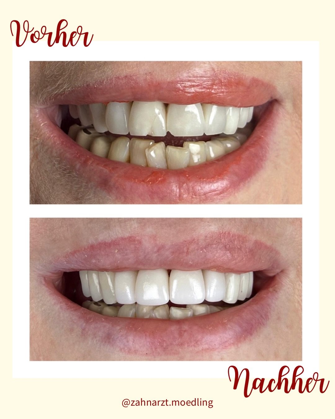 ✨ Neue Frontz&auml;hne in nur einer Sitzung
Abgebrochene Kronen ersetzt, Farbe aufgehellt &amp; Zahnform harmonisiert 🦷
Dank CEREC: digital geplant, direkt gefertigt &amp; sofort eingesetzt.