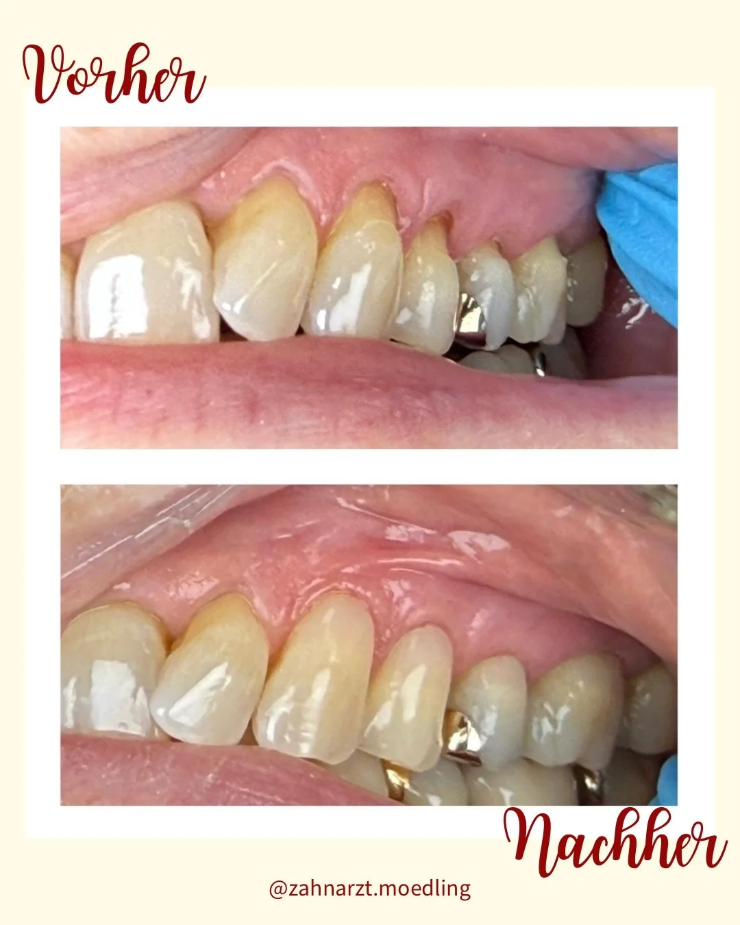Schmerzfrei. Nat&uuml;rlich. Gesch&uuml;tzt. 🦷✨#z&auml;hne #zahnf&uuml;llung #zahnarztm&ouml;dling