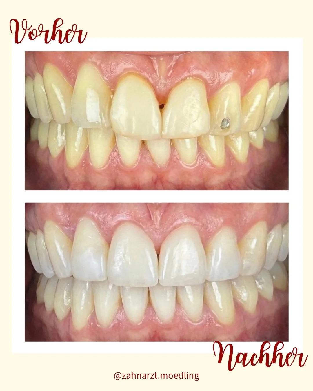 Veneer-Austausch f&uuml;r mehr Nat&uuml;rlichkeit und Harmonie🦷

#zahnarztm&ouml;dling #gesundez&auml;hne #zahngesundheit