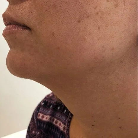 Hair-Removal-EXCELIGHT-and-Motus-AY-Setsuko-Beauty.jpg