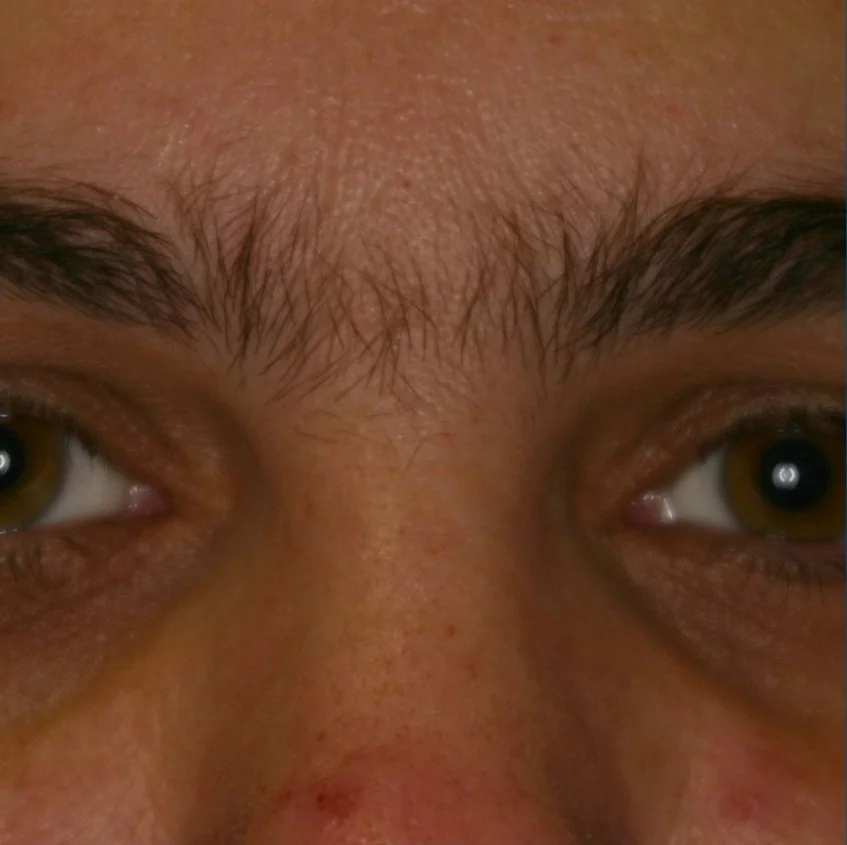 EXCELIGHT - Hair Removal Eyebrow.jpg