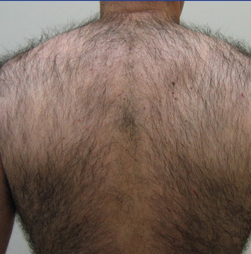 EXCELIGHT - Hair-Removal Back.jpg