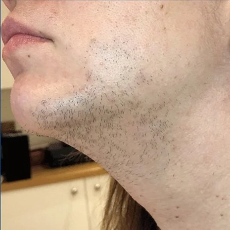 Hair-Removal-EXCELIGHT-and-Motus-AY-Setsuko-Beauty.jpg