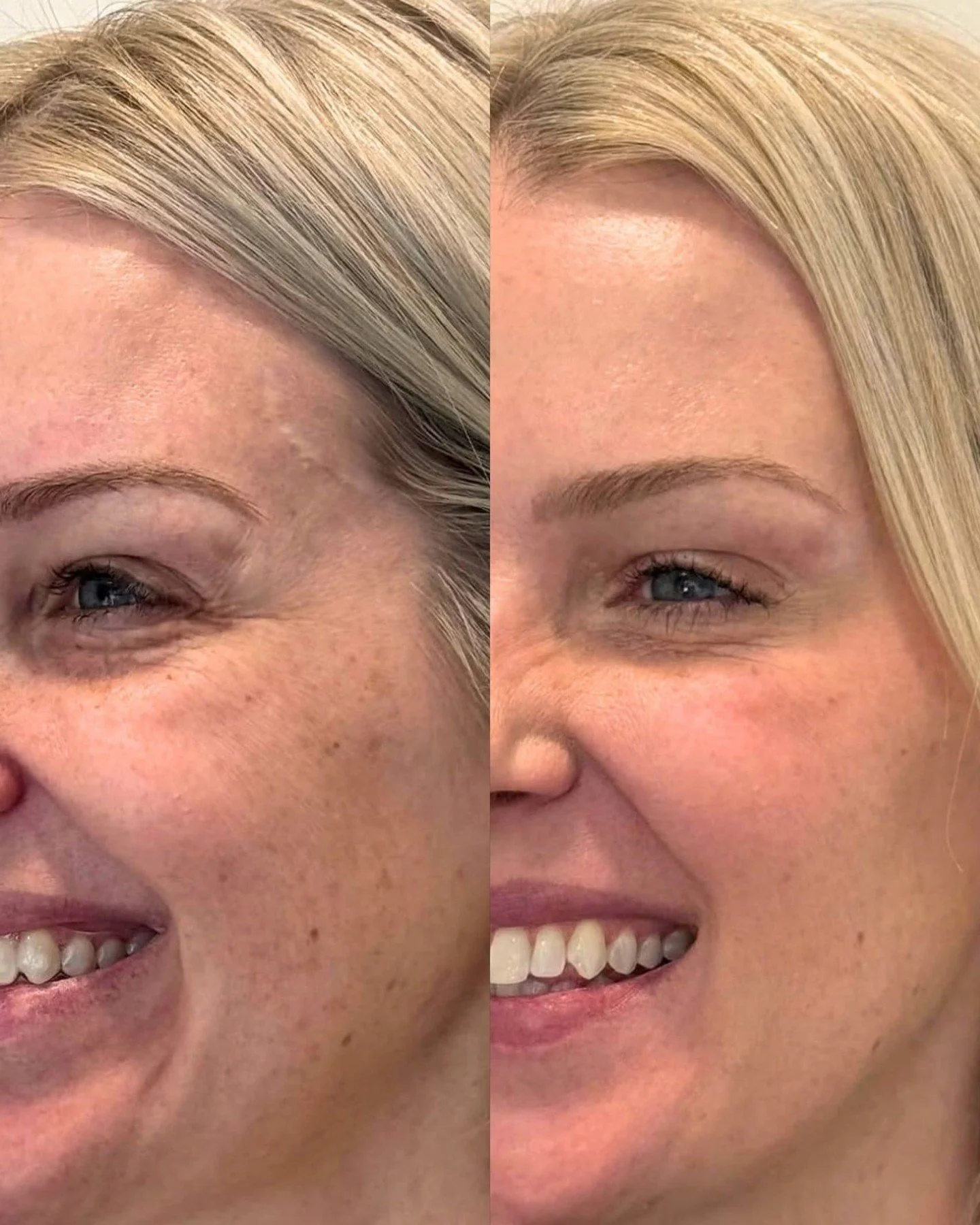 You smile, and the lines at the corners of your eyes stay put long after the smile is gone.

That&rsquo;s your orbicularis oculi, the muscle that wraps around your eye. Every laugh, squint, and drive into the sun folds the skin in the same spot. Afte
