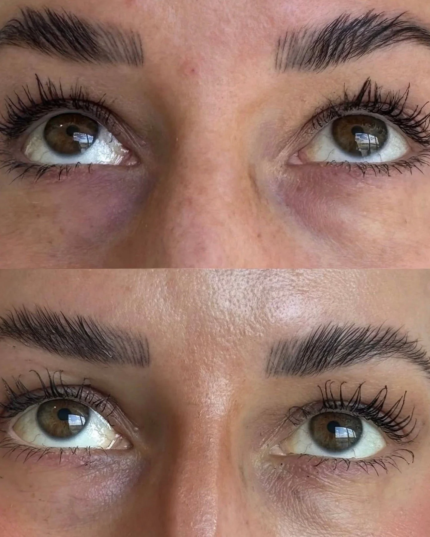 You&rsquo;ve tried the color-correcting concealer. The brightening eye cream. Eight full hours of sleep, for once. And the shadows are still there.

This comes up all the time in consults. The woman across from me isn&rsquo;t asking for anything dram