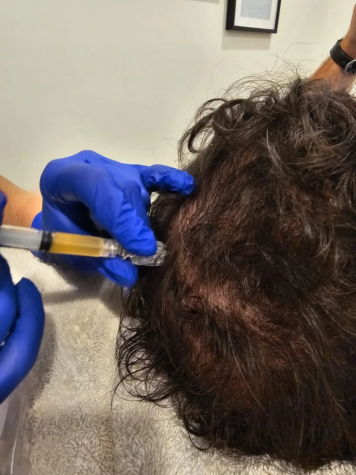 PRP - Hair Restoration