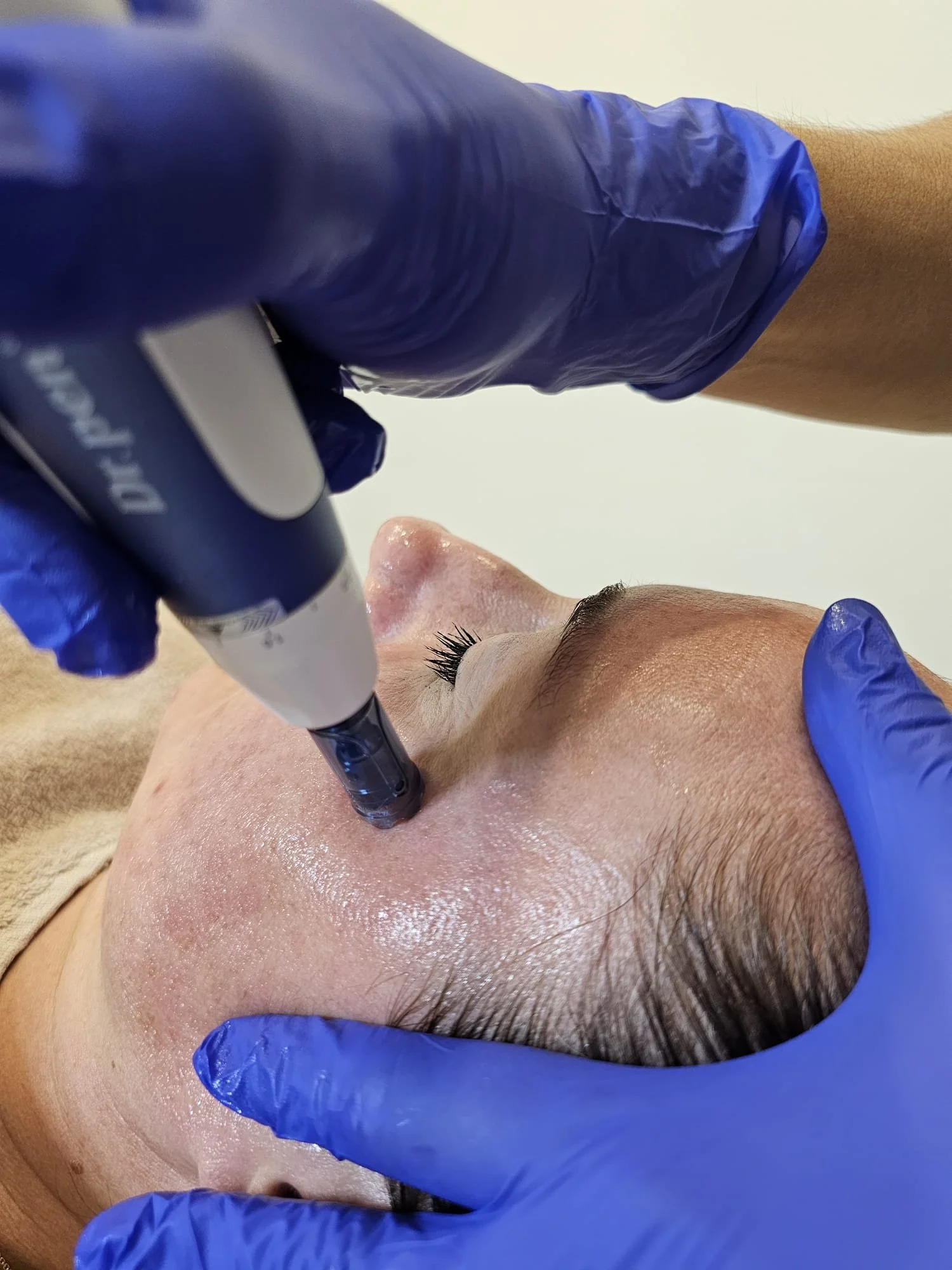 NCTF for Microneedling 