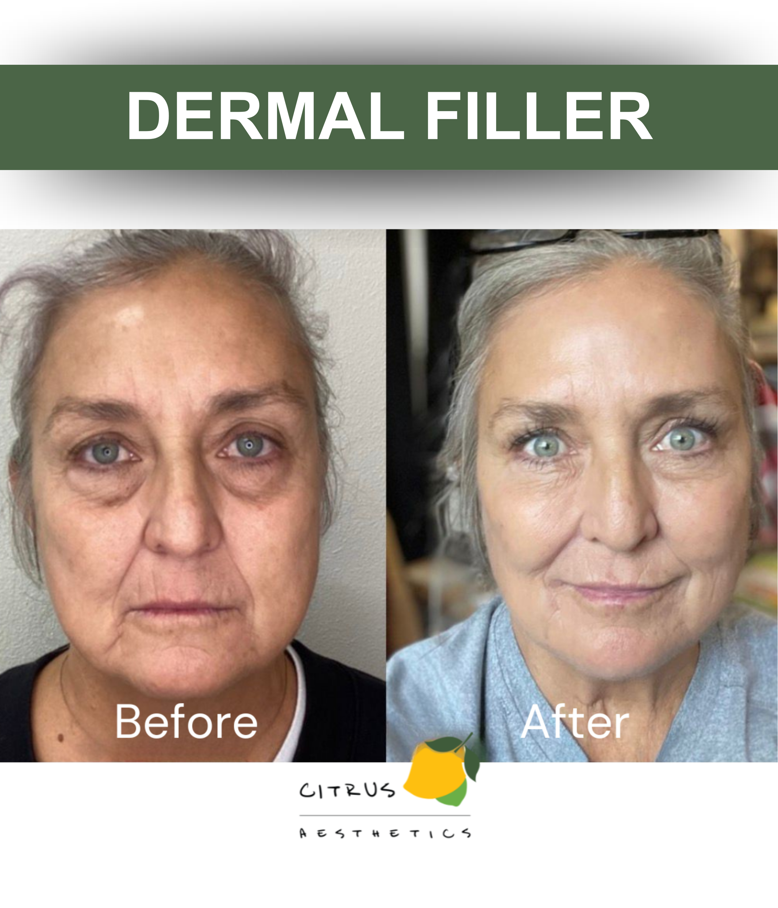 Citrus Aesthetics Dermal Fillers