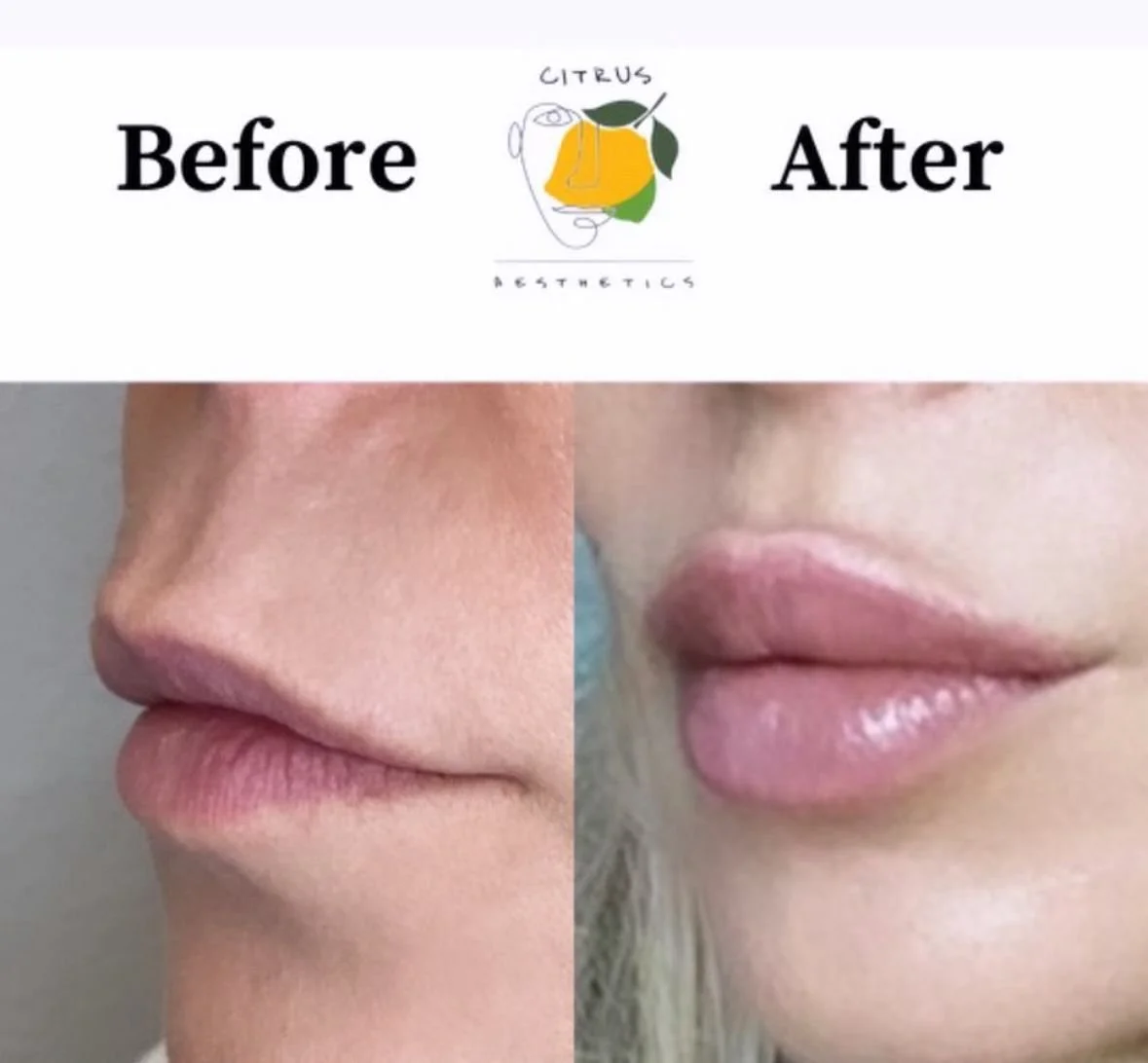 What Really Happens During a Lip Filler Appointment: A Citrus Aesthetics Guide for Natural, Soft Lips