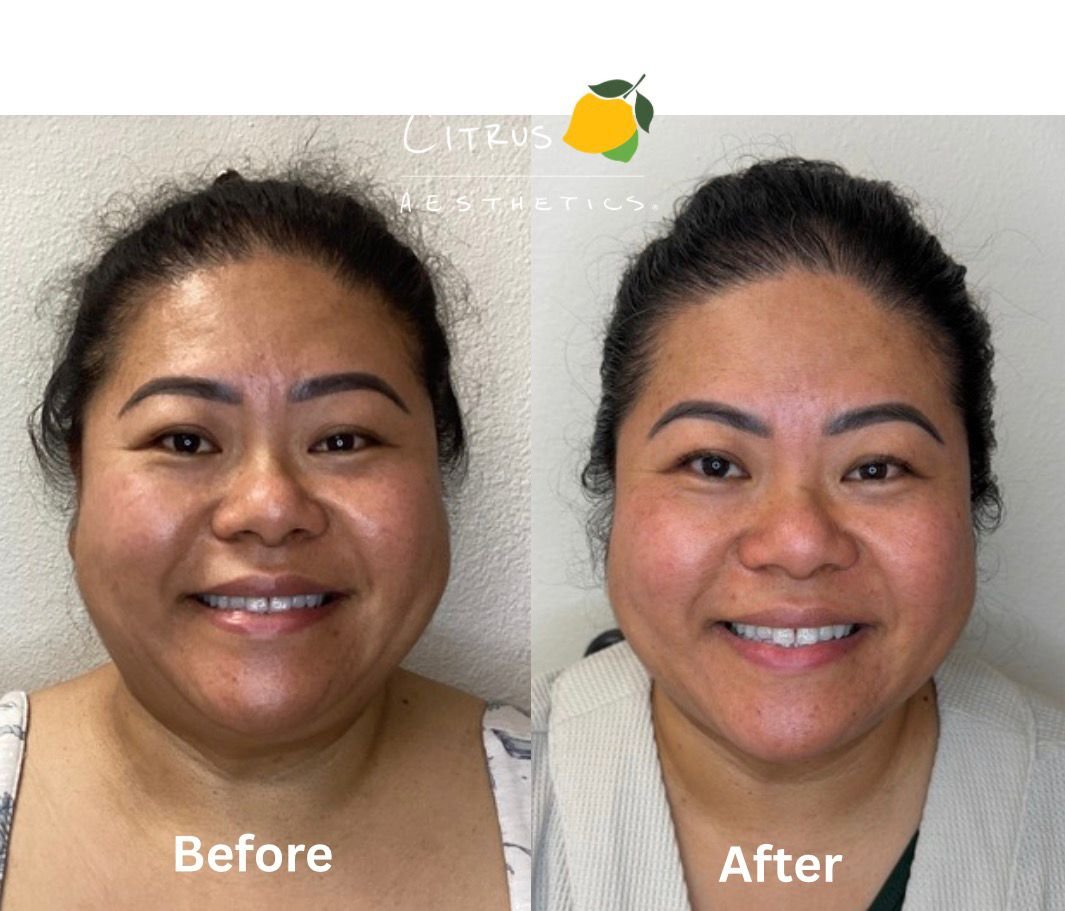 What Is RF Microneedling and Why Is Everyone in San Diego Talking About It?