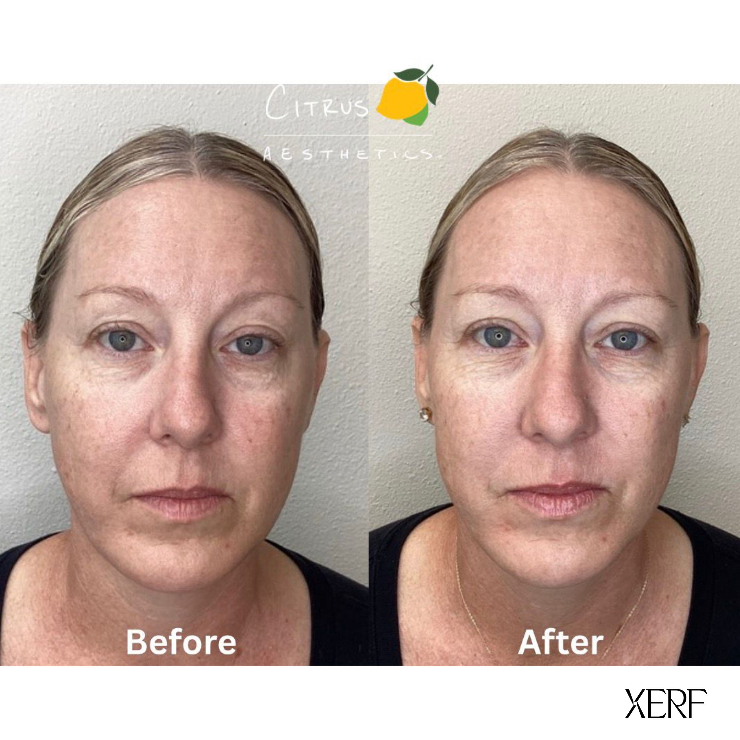 XERF Skin Tightening in Mission Valley: A Gentle, Modern Way to Refresh Your Look